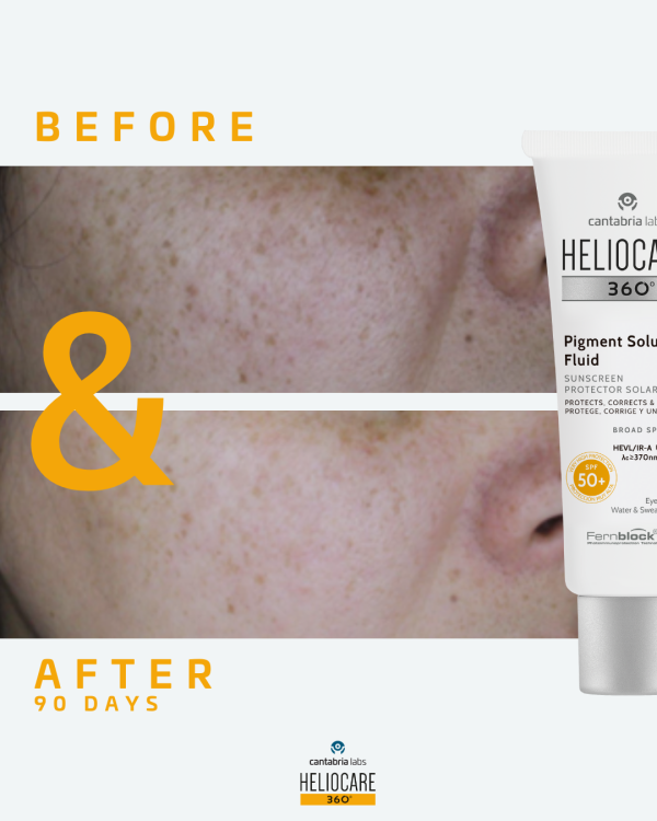Heliocare 360° Pigment Solution Fluid Before & After